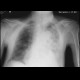 Upside-down stomach: X-ray - Plain radiograph